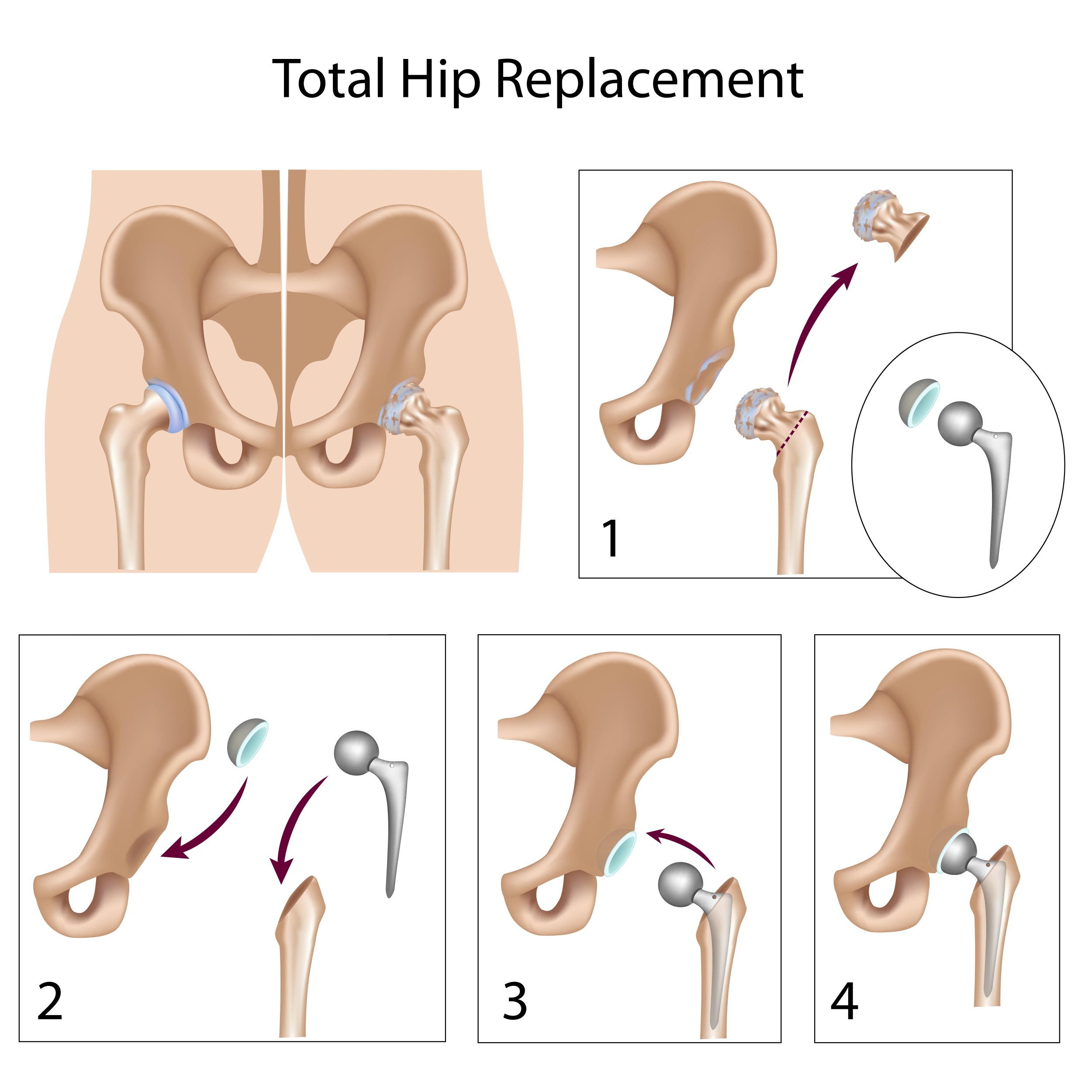 Minimally invasive anterior hip arthroplasty (Hueter) Dr. Michael Serhal